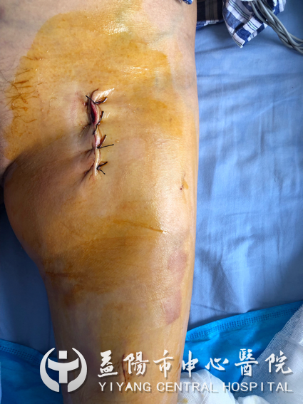 患者左下肢手术伤口.png